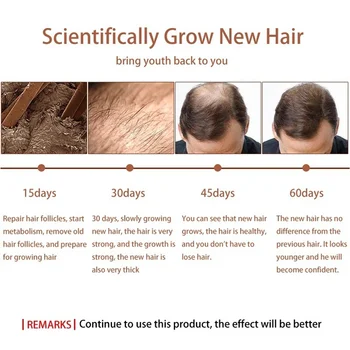 MeiYanQiong 20ML Greitai Galingas Plaukų Augimo Esmė Plaukų Slinkimas Produktų eterinis Aliejus Skystas Gydymo užkirsti Kelią Plaukų Slinkimas, Plaukai